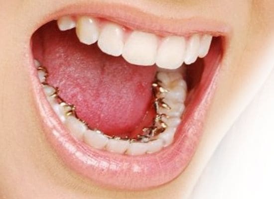 Brackets linguales en Zaragoza