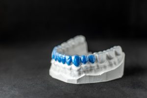 Alineadores invisibles o brackets: alineador transparente colocado sobre un modelo dental