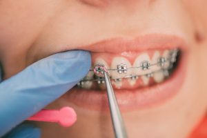 Bracket suelto: la ortodoncista recoloca un bracket despegado en una urgencia de ortodoncia