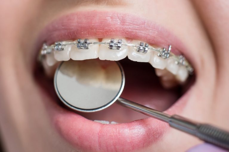 Brackets autoligables vistos de cerca: la tapa sujeta el arco y no hay ligadura elástica