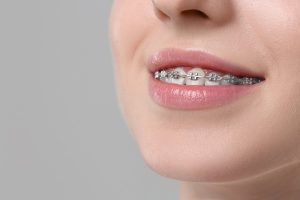 Brackets autoligables: brackets metálicos sin ligaduras elásticas sobre los dientes