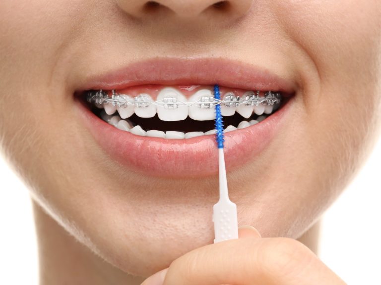 Mujer con brackets pasando un cepillo interdental entre bracket y encía