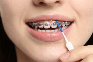 Cómo limpiar los brackets: cepillo interdental pasando entre los brackets durante la ortodoncia