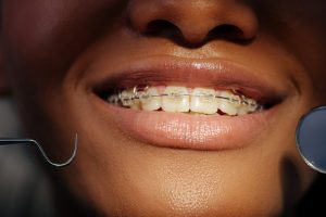Sonrisa con brackets sin llagas ni rozaduras tras la revisión de ortodoncia