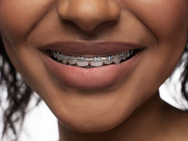 Sonrisa de una persona adulta con brackets metálicos
