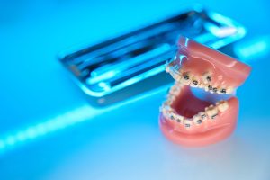 Tipos de brackets: modelo dental con brackets metálicos vistos de cerca en la clínica de ortodoncia