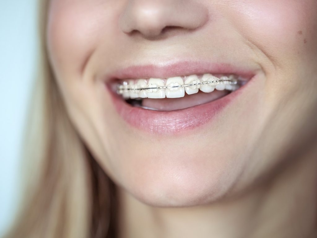 Brackets estéticos del color del diente sobre una sonrisa, con el arco metálico a la vista