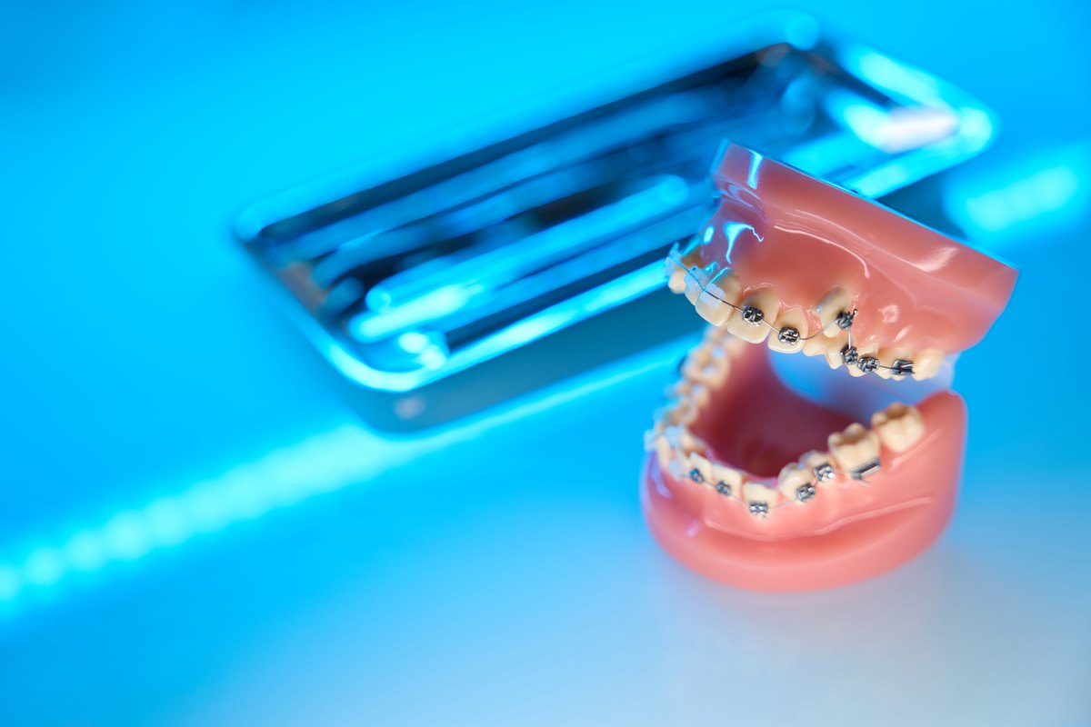 Tipos de brackets: modelo dental con brackets metálicos vistos de cerca en la clínica de ortodoncia