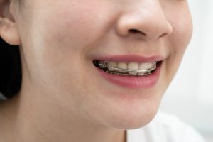 Primer plano de la sonrisa de una joven con un aparato removible de alambre que pasa por delante de los dientes de arriba