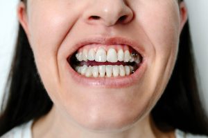 Parte baja de la cara de una mujer que enseña los dientes con la boca entreabierta, con pequeños ataches del color del diente y botones metálicos en los laterales