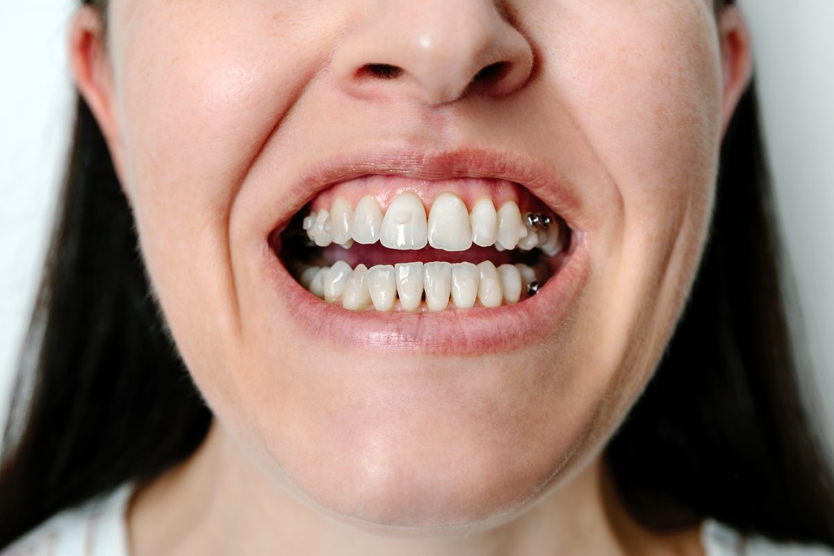 Parte baja de la cara de una mujer que enseña los dientes con la boca entreabierta, con pequeños ataches del color del diente y botones metálicos en los laterales