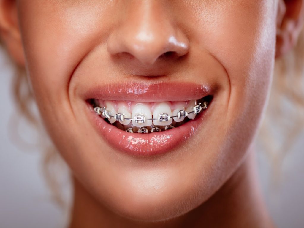 Brackets metálicos de acero: sonrisa con brackets metálicos en los dientes