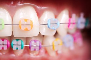 Primer plano de dientes con brackets estéticos y una goma de color distinto en cada uno: naranja, azul, rosa, verde, morado y amarillo