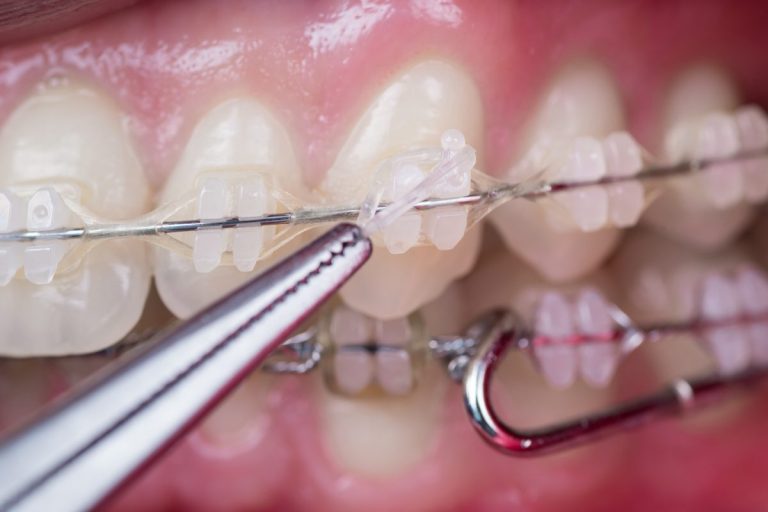 Primer plano de dientes con brackets transparentes y alambre metálico, mientras unas pinzas colocan una goma transparente sobre el alambre