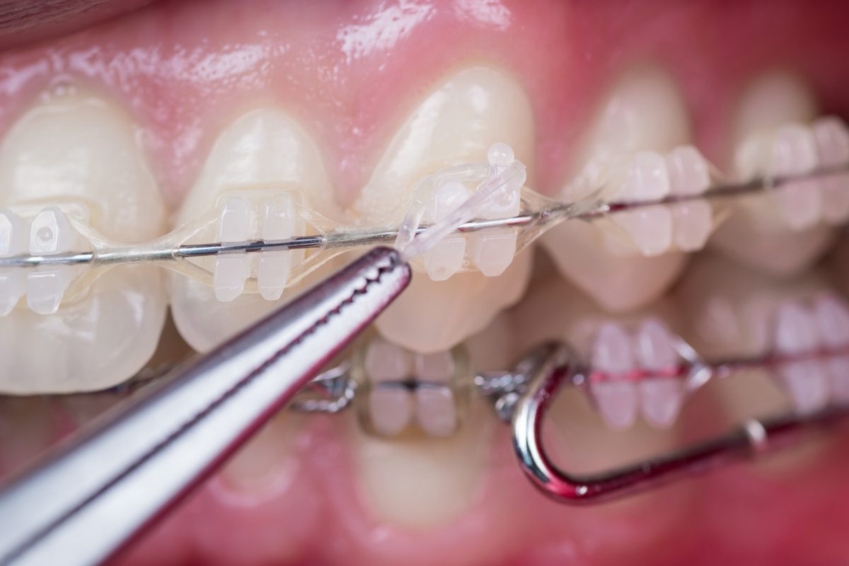 Primer plano de dientes con brackets transparentes y alambre metálico, mientras unas pinzas colocan una goma transparente sobre el alambre