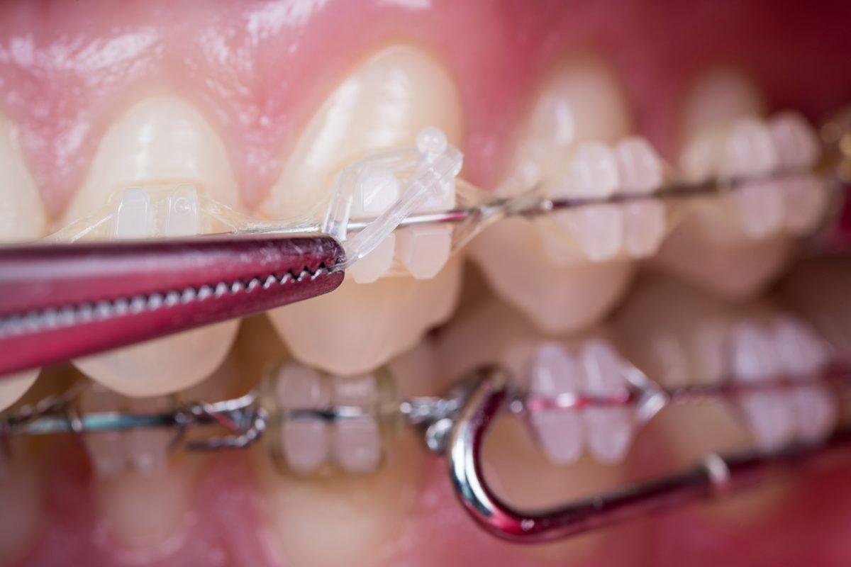 Primer plano de dientes con brackets transparentes y su alambre, con unas pinzas que sujetan una ligadura y un instrumento dental apoyado en el arco de abajo