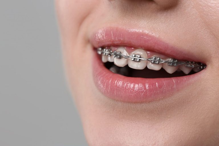 Primer plano de una boca sonriente con brackets metálicos y su alambre en los dientes de arriba, sobre fondo gris