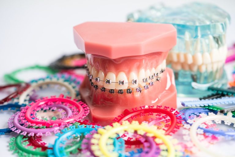 Modelo dental con brackets metálicos en las dos arcadas, rodeado de anillos de ligaduras elásticas de colores para ortodoncia