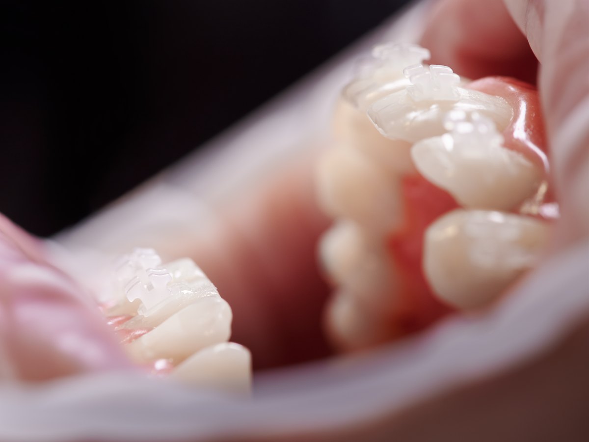 Problemas que soluciona la ortodoncia: brackets ortodónticos blancos en los dientes del paciente